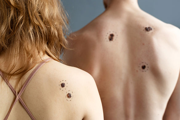 Back view of female and male with melanoma