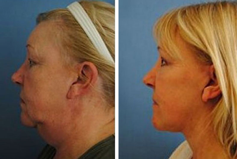 GraceMed Square One | Dr. McLean | 3 Day Facelift