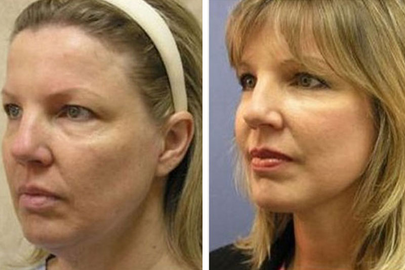 GraceMed Mississauga | Dr. McLean | 3 Day Facelift