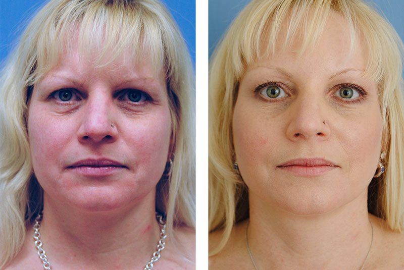GraceMed Mississauga | Dr. McLean | 3 Day Facelift