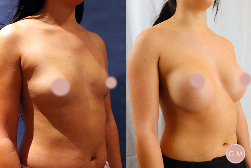 Before and After | GraceMed Breast Augmentation Age 28
