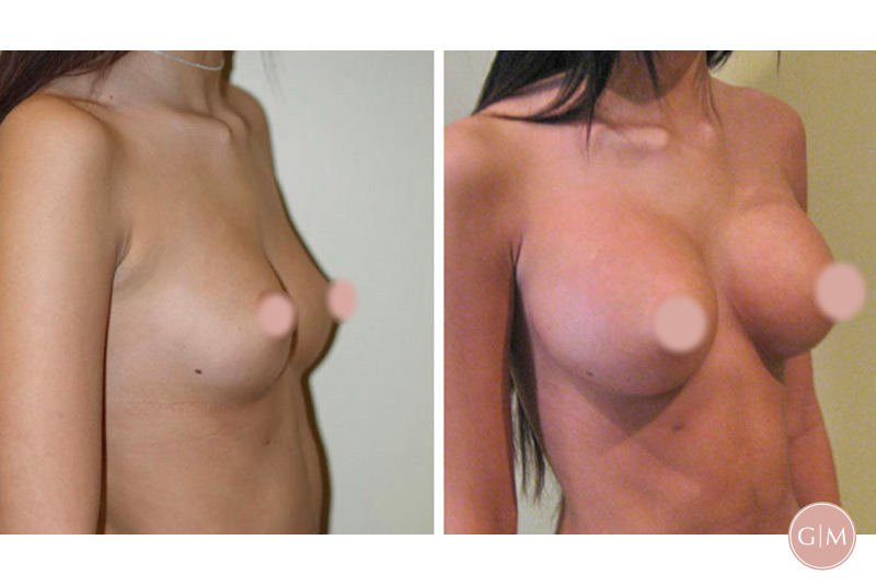Before and After | GraceMed Breast Augmentation