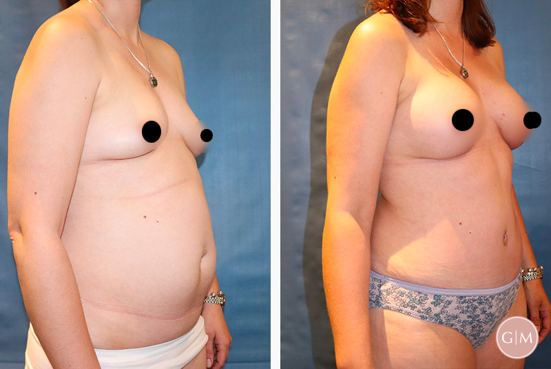 Mommy Makeover (Tummy Tuck + Breast Augmentation) - Age 41