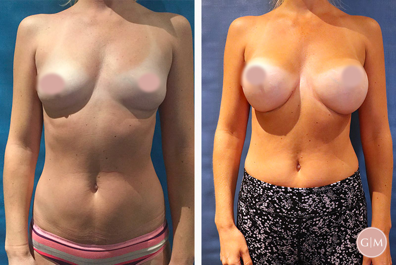 Before and After | GraceMed Breast Augmentation Age 40