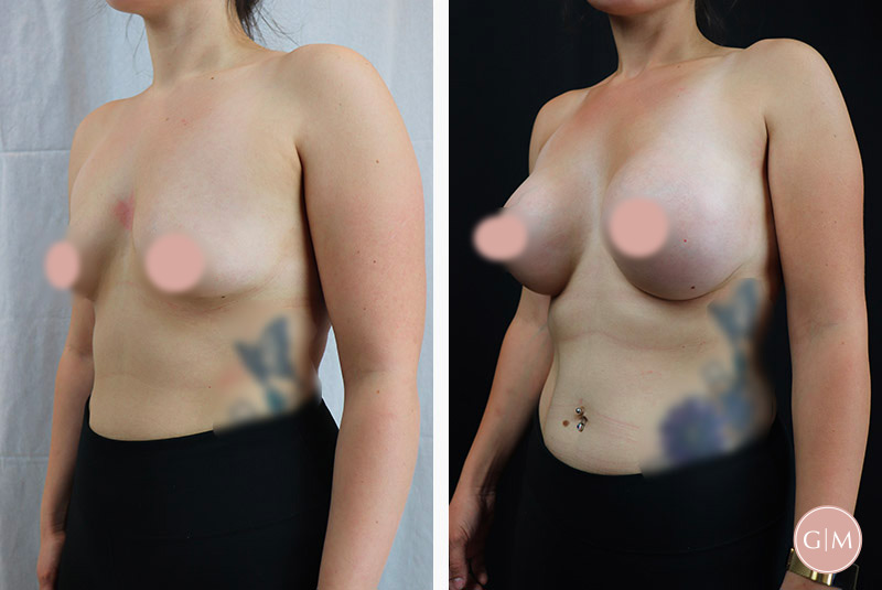 Before and After | GraceMed Breast Augmentation Age 31