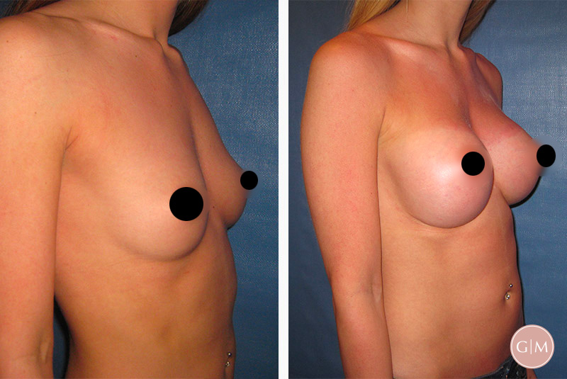 Before and After | GraceMed Breast Augmentation Age 22