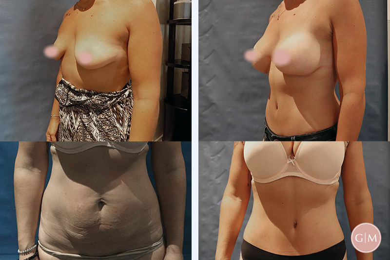 Before and After | GraceMed Breast Mommy Makeover