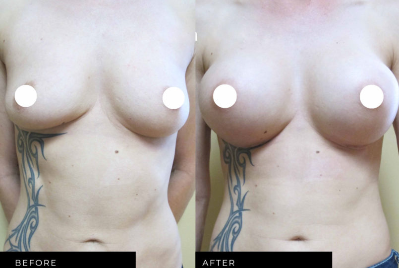 Dr. Reza | Before and After | Breast Augmentation | GraceMed Burlington Cosmetic Surgery