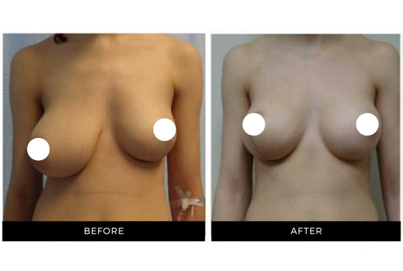 Dr. Shortt | Before and After | Breast Lift | GraceMed Oakville Cosmetic Surgery