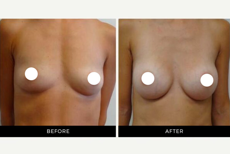 Dr. Shortt | Before and After | Breast Implants | GraceMed Oakville Cosmetic Surgery
