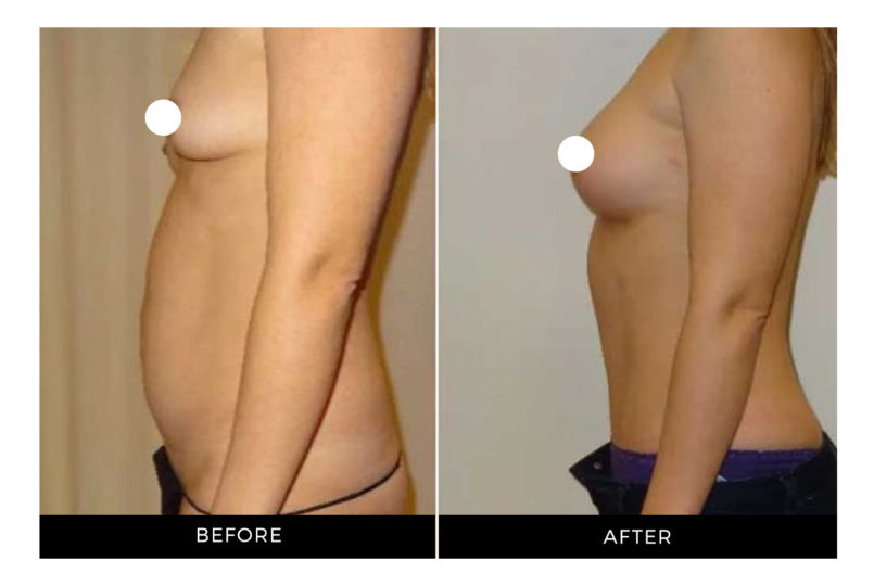 Dr. Shortt | Before and After | Tummy Tuck | GraceMed Oakville Cosmetic Surgery