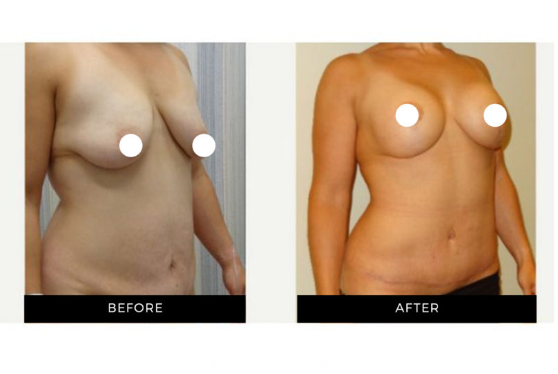 Dr. Shortt | Before and After | Breast Augmentation | GraceMed Oakville Cosmetic Surgery
