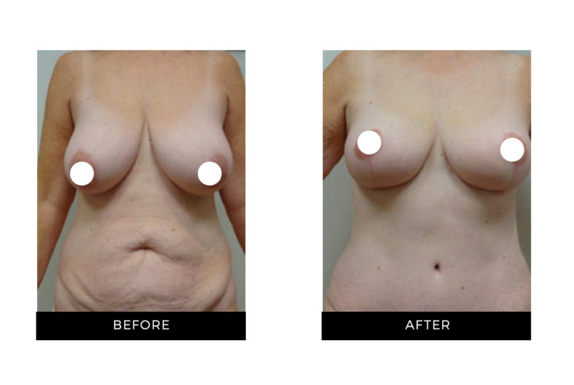 Dr. Shortt | Before and After | Tummy Tuck | GraceMed Oakville Cosmetic Surgery
