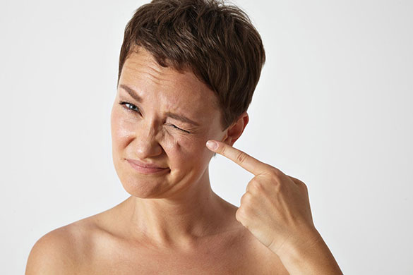 Woman squinting and pointing to aging signs around her left eye