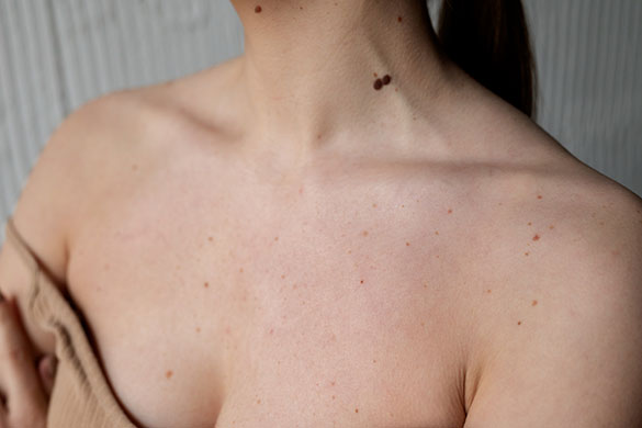 Close up of woman’s neck and shoulders with melanoma