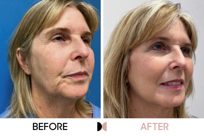GraceMed face and neck lift and fat grafting
