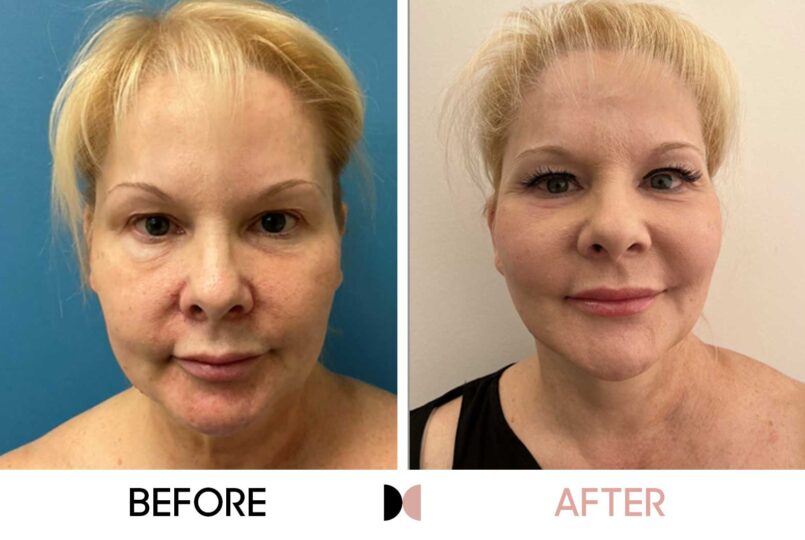 GraceMed Face and Neck Lift w Fat Grafting and Laser Resurfacing