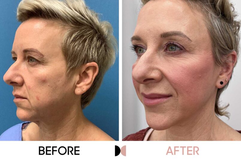 GraceMed 6 month face and neck lift