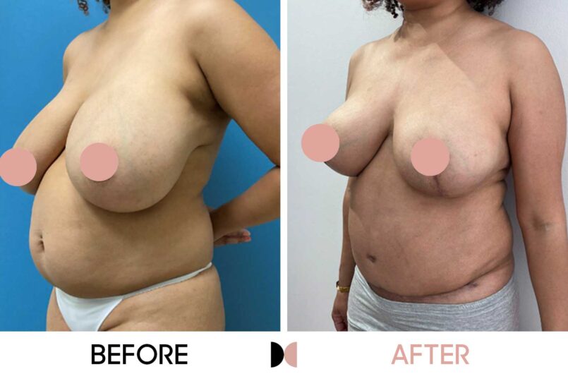GraceMed 3 months postop Breast Reduction & Tummy Tuck