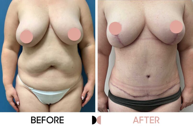 GraceMed Breast Reduction & Tummy Tuck, 5 months