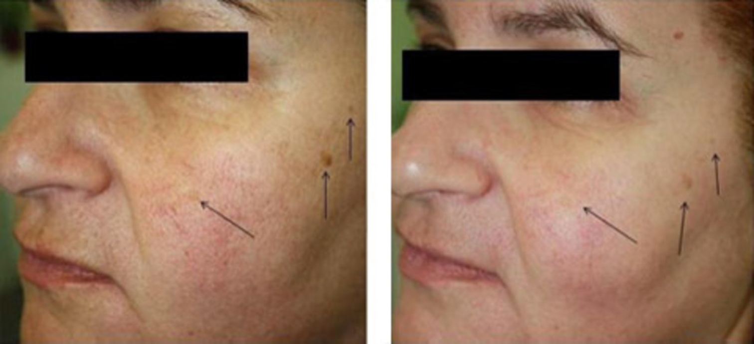 Oxygeneo Facial Before & After