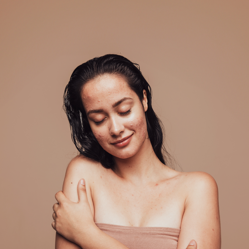 women with skin blemishes smiling with eyes closed against brown background