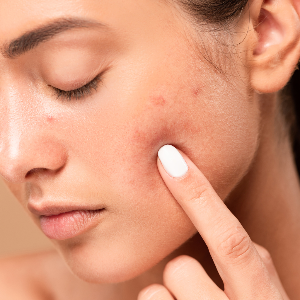 Close up of women with discoloured skin on a cream background