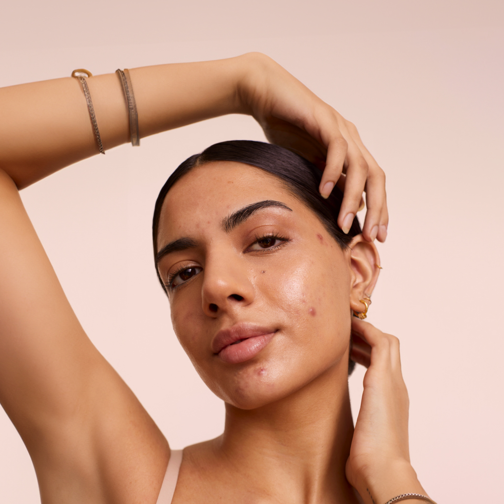 caramel skinned women with skin blemishes on a beige background