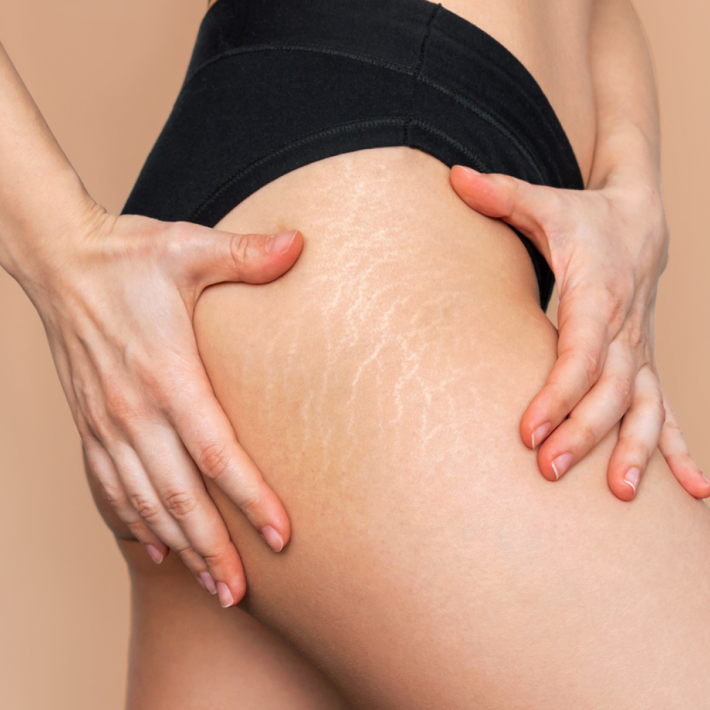 close up of a female thigh with stretch marks wearing black body suit