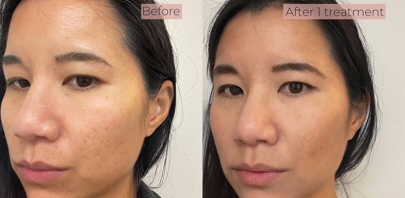 GraceMed Vampire Facial Before and After