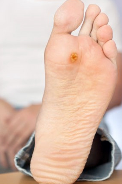 wart on the bottom of man's foot